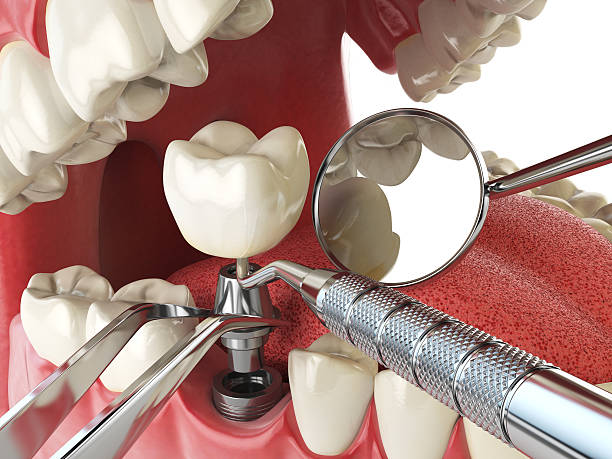 Best Emergency Dentist for Knocked-Out Tooth in Traverse City, MI